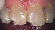 Washington DC dentist chipped teeth